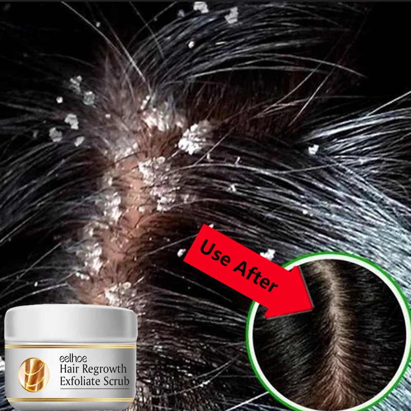 Hair Care Dandruff - สครับขจัดรังแคสูตรเร่งด่วน บรรเทาอาการคัน ทำความสะอาดหนังศีรษะ ผลิตภัณฑ์ขัดผิว ควบคุมความมัน ป้องกันอาการคัน