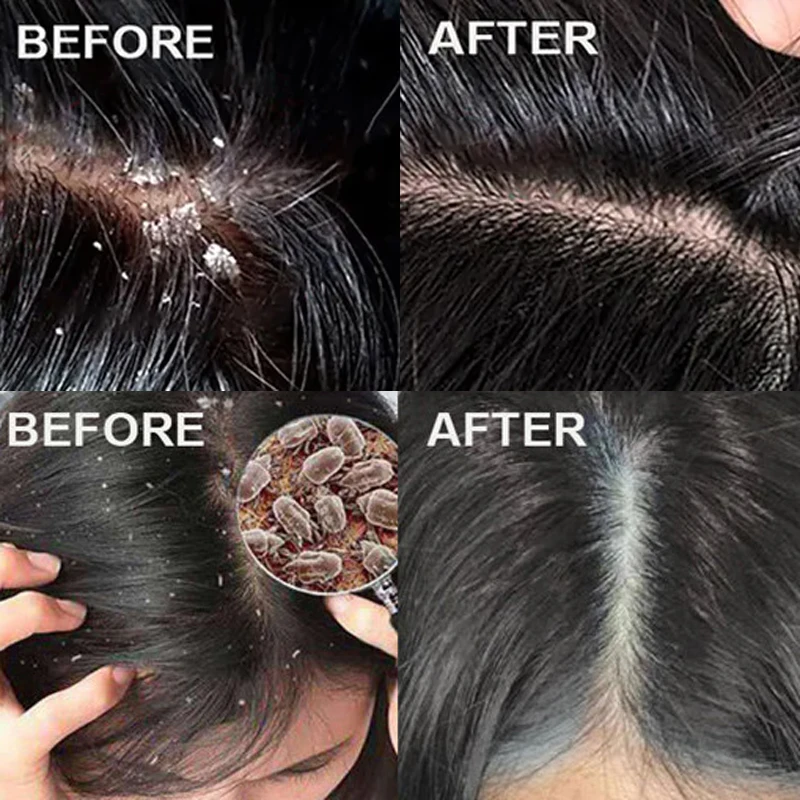 สครับขจัดรังแคสูตรเร่งด่วน บรร - Hair Care Dandruff บทวิจารณ์และราคา