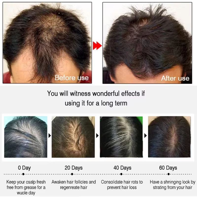 สเปรย์เร่งผมยาวขึ้นอย่างรวดเร็ - Hair Care For Hair Growth บทวิจารณ์และราคา